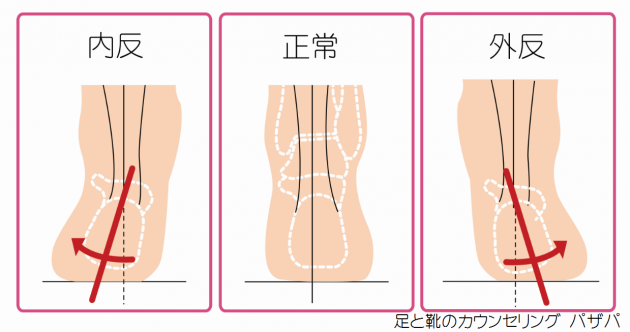 踵　内外反